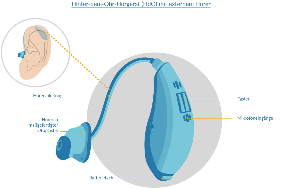 Hinter-dem-Ohr-Hörgerät mit externem Hörer