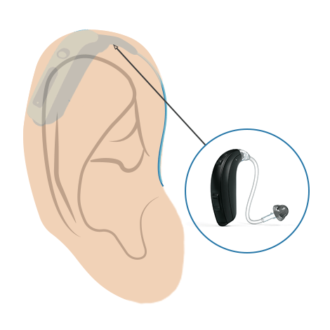 Hörgeräte Bauform: Hinter-dem-Ohr-Hörgerät