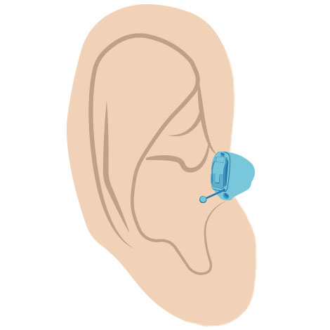 Im-Ohr-Hörgerät - so wird es getragen
