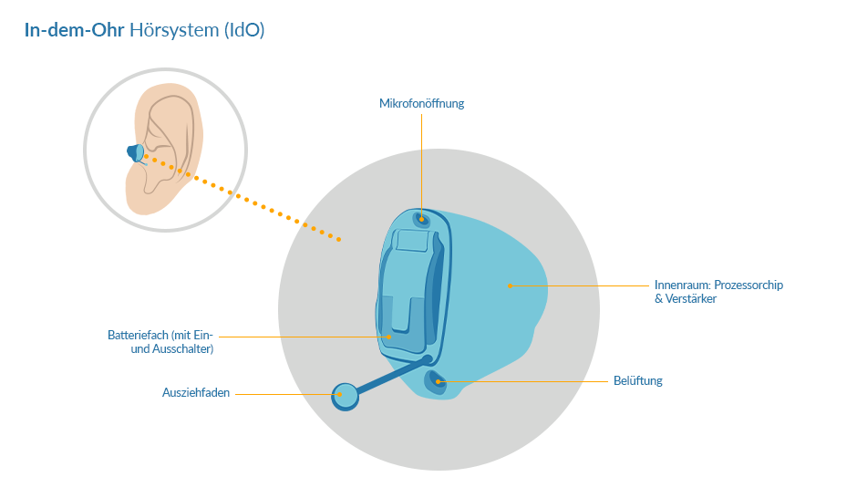 Bauteile eines Im-Ohr-Hörgerätes